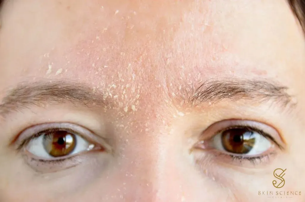 Dry, flaking skin across the forehead