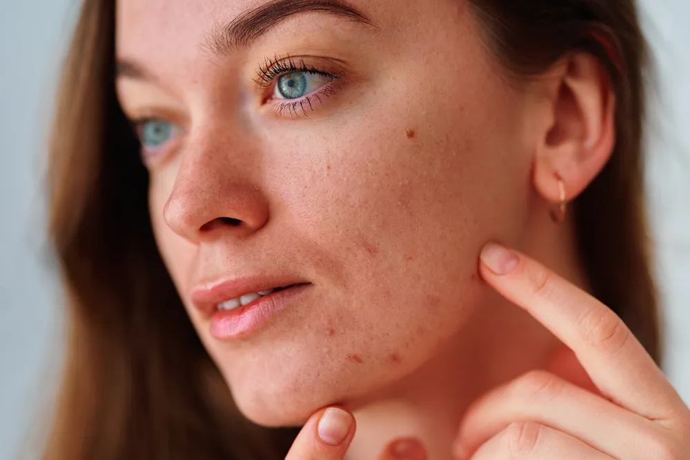 Dry skin on the face