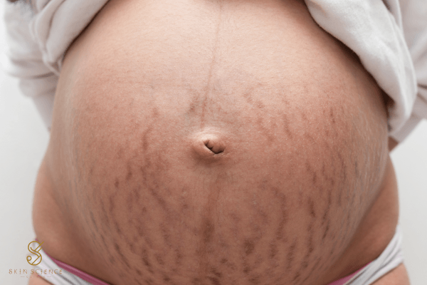 Stretch marks across the abdomen during pregnancy