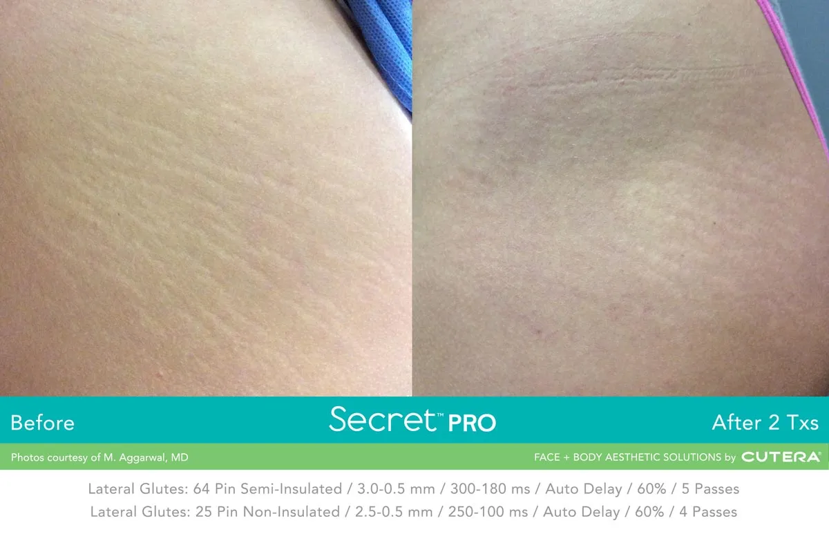 Causes, Diagnosis, and Treatment of Stretch Marks