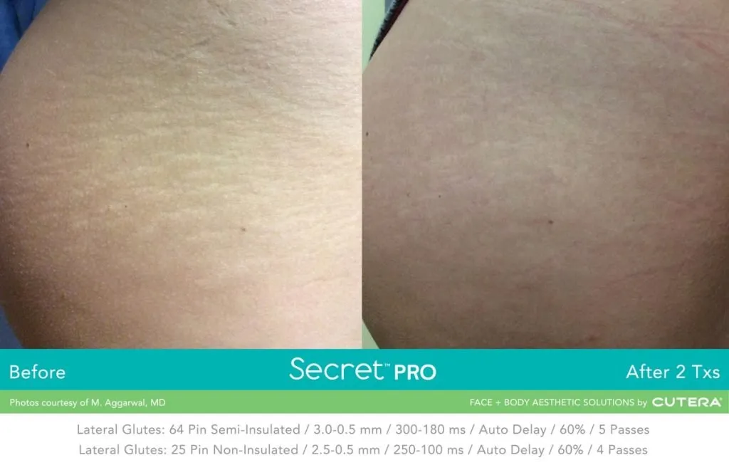 Causes, Diagnosis, and Treatment of Stretch Marks