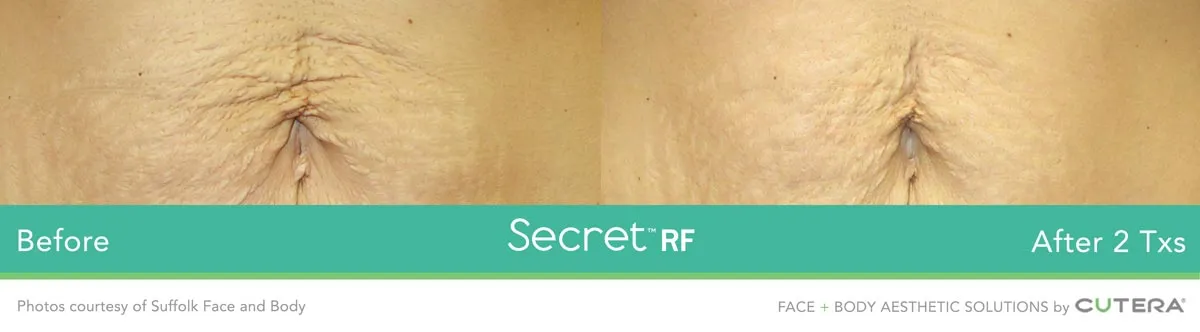 Causes, Diagnosis, and Treatment of Stretch Marks
