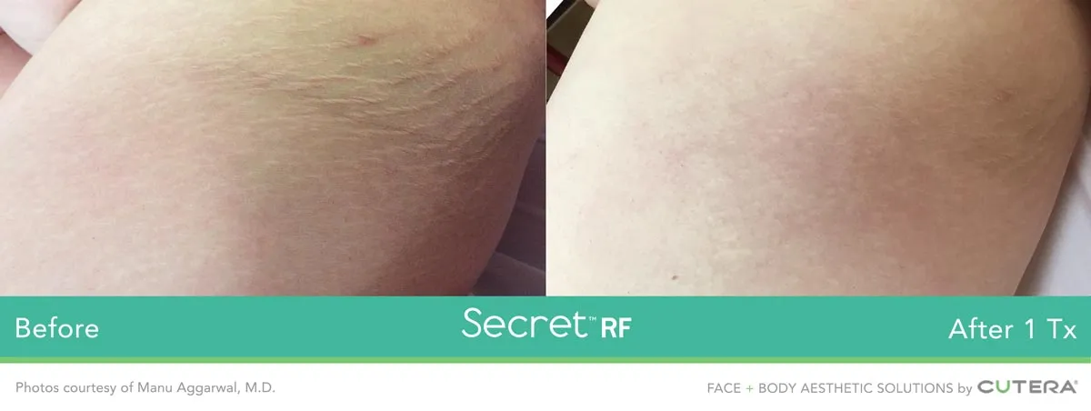 Causes, Diagnosis, and Treatment of Stretch Marks