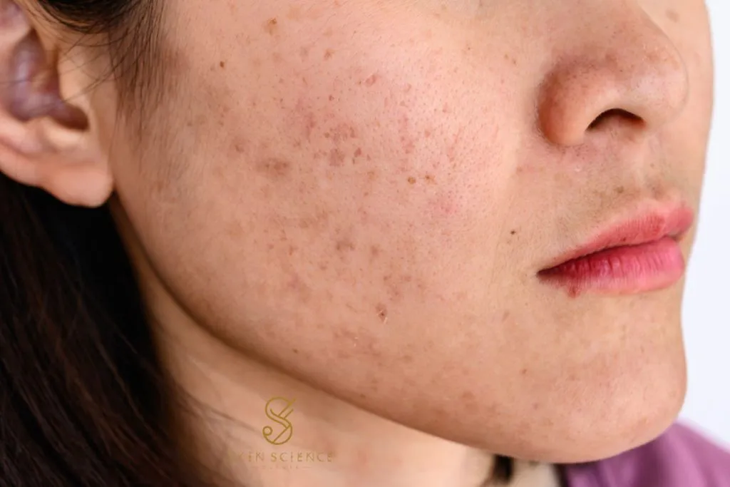 A young woman with melasma pigmentation across her cheeks