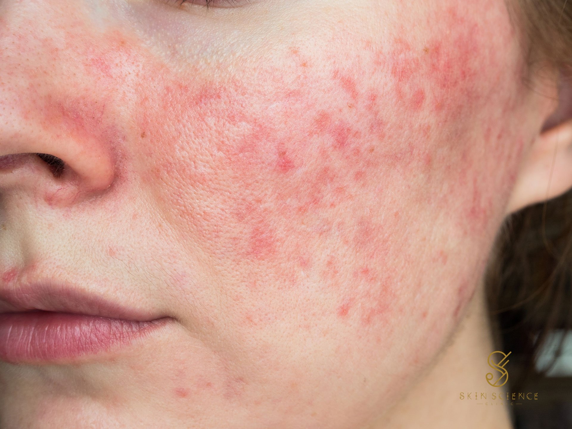 Close-up of facial redness caused by rosacea