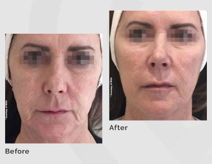 Profhilo before and after results at Skin Science Clinic London