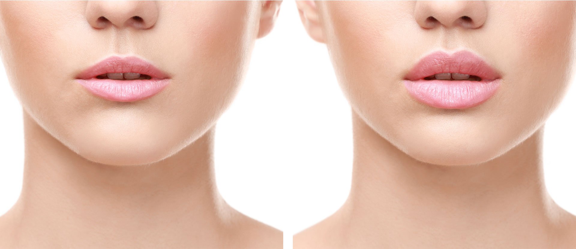 Lip filler treatment at Skin Science Clinic, London