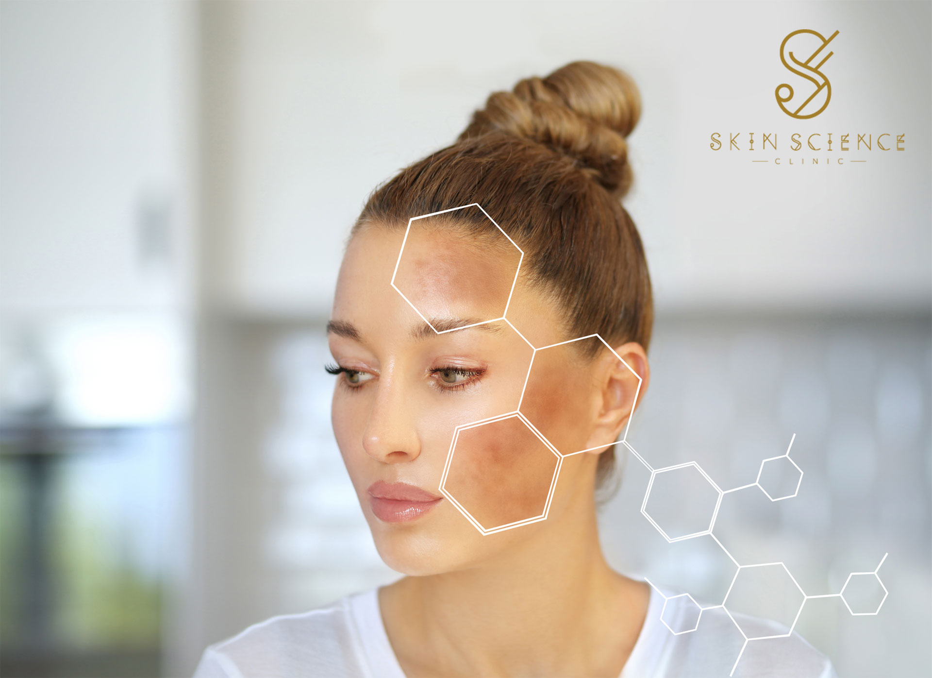 Hyperpigmentation on the skin, and what causes it