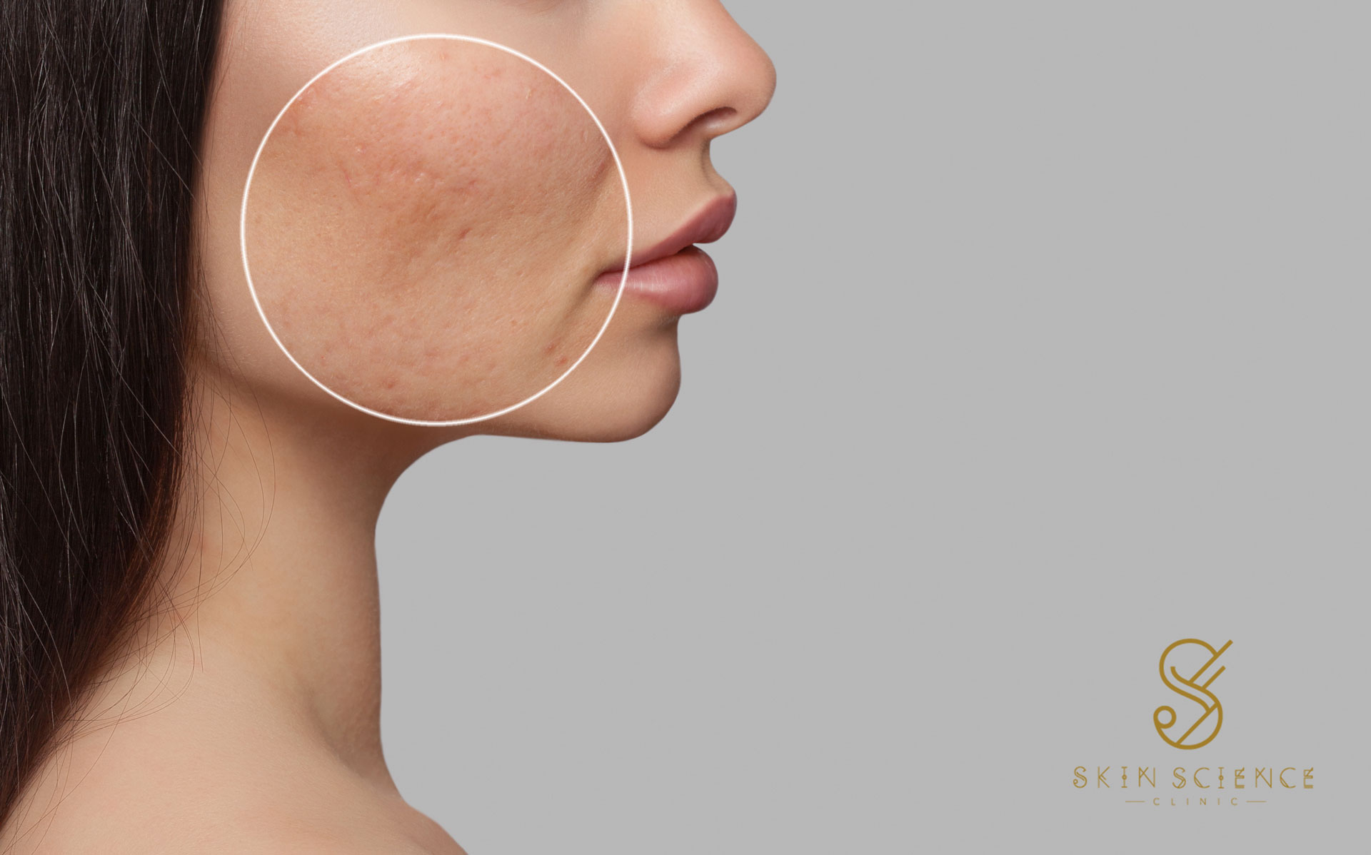 Acne scarring treated at Skin Science Clinic, London