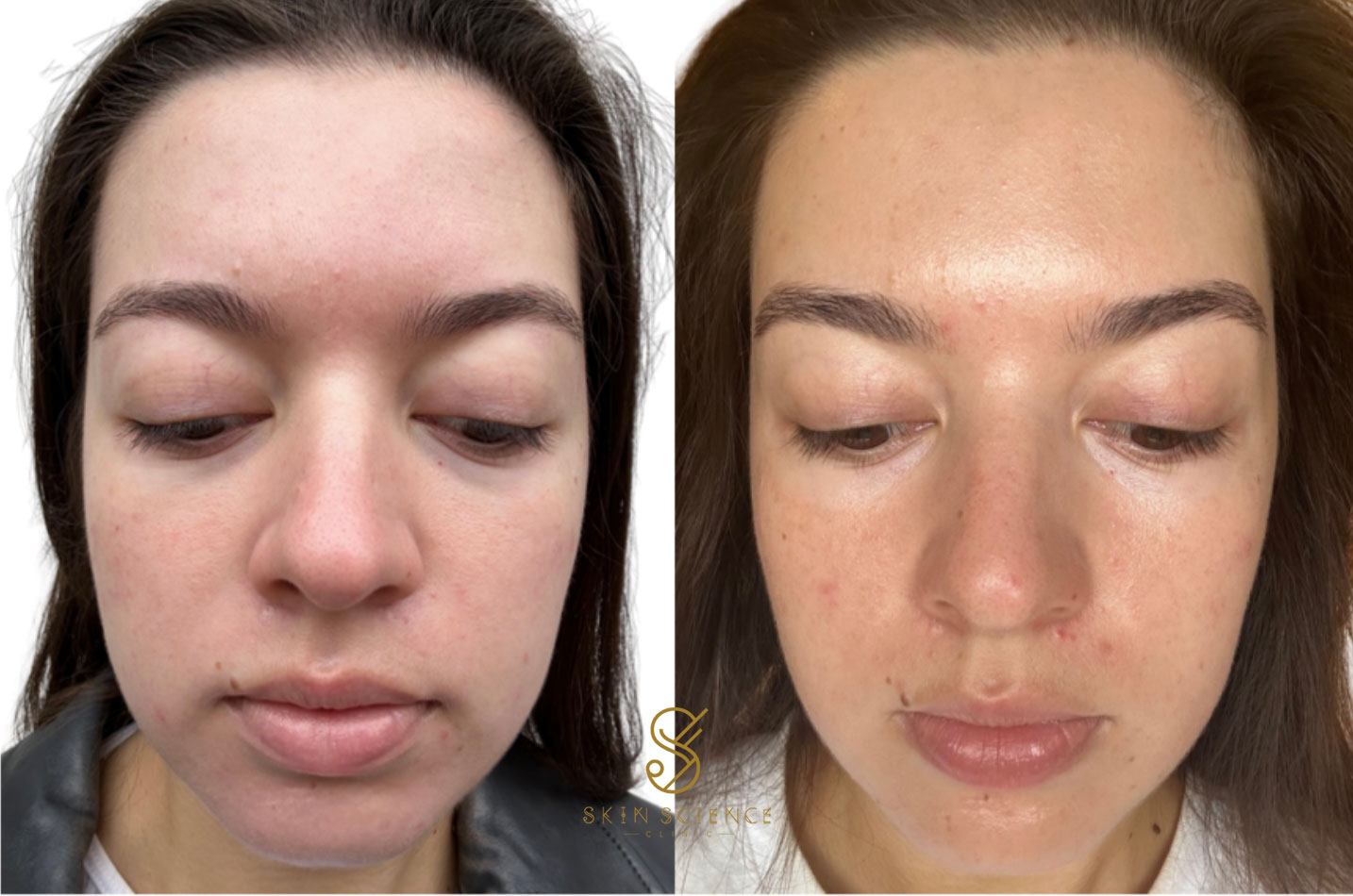 Before and after MOXI and BBL treatment