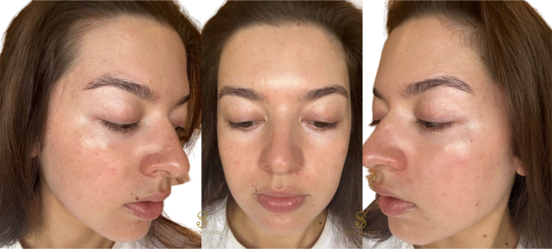 Skin one week after MOXI and BBL treatment