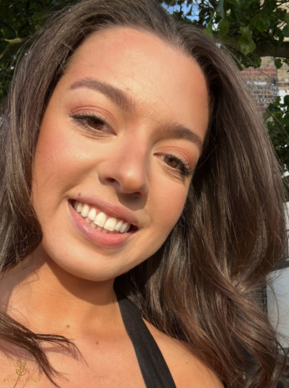 Skin Science Clinic patient after their BBL and Moxi treatment in London