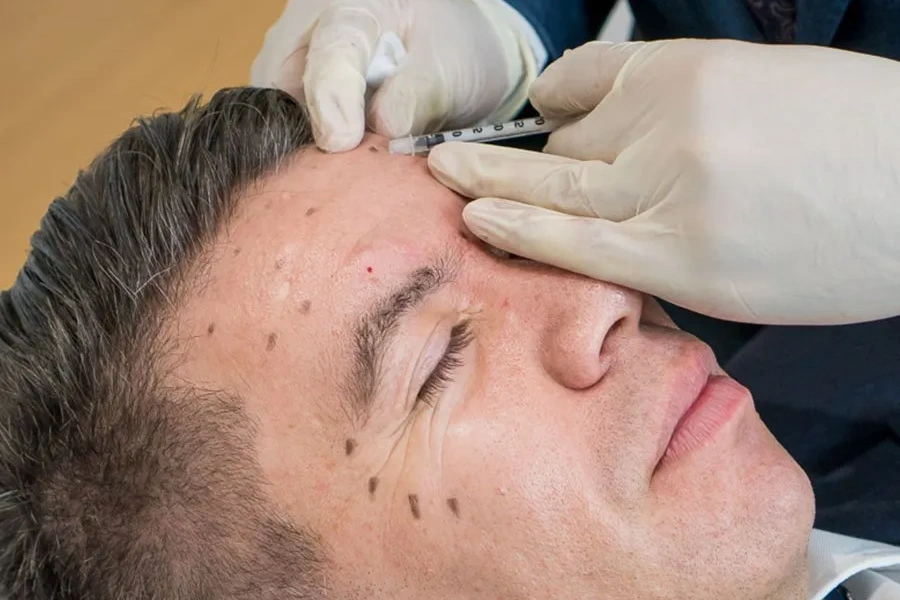 Forehead filler smoothing the upper face