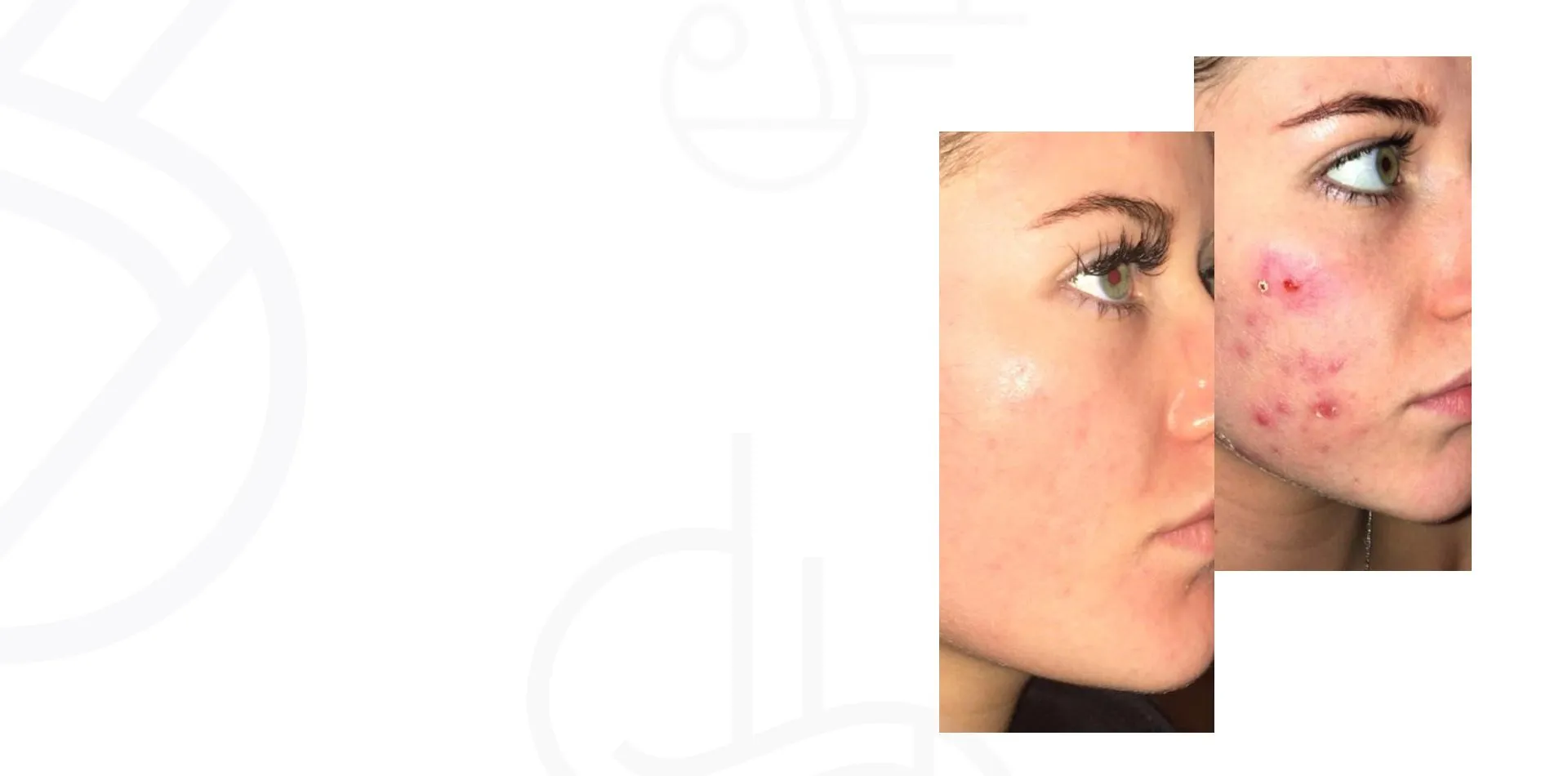 A patient's skin before and after a 3 Step ZO Peel