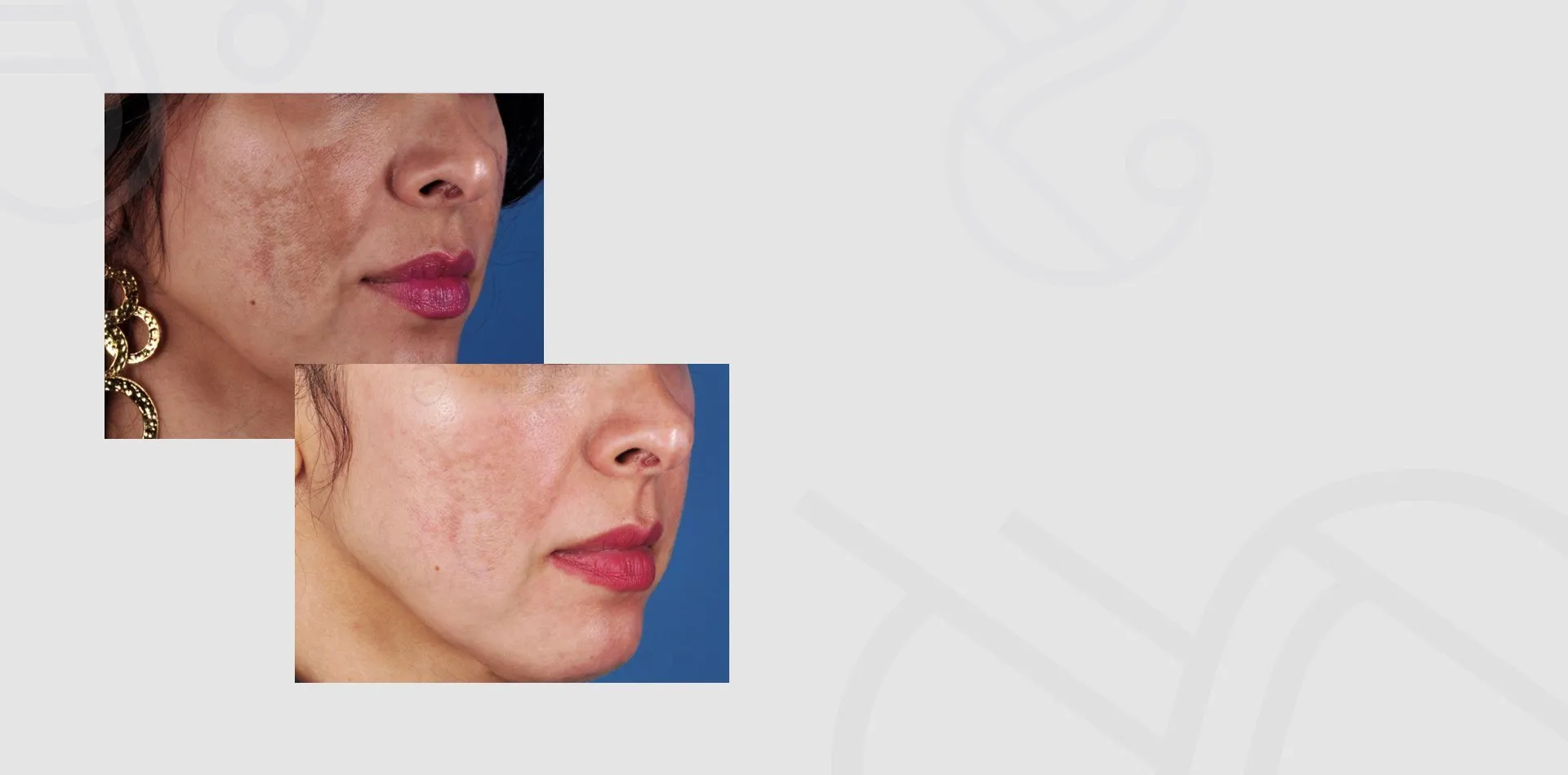 Before and after a 3 Step ZO Peel at Skin Science Clinic, London