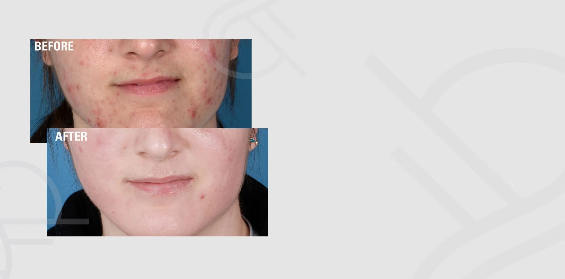 Before and after acne treatment at Skin Science Clinic, London