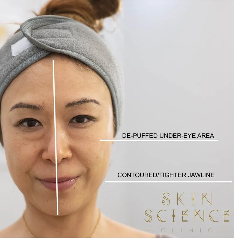 Cryotherapy before and after detail on a dark-skinned woman