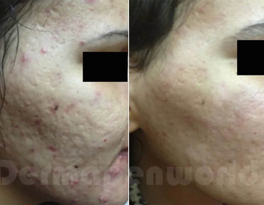Before and after Dermapen treatment at Skin Science Clinic in London