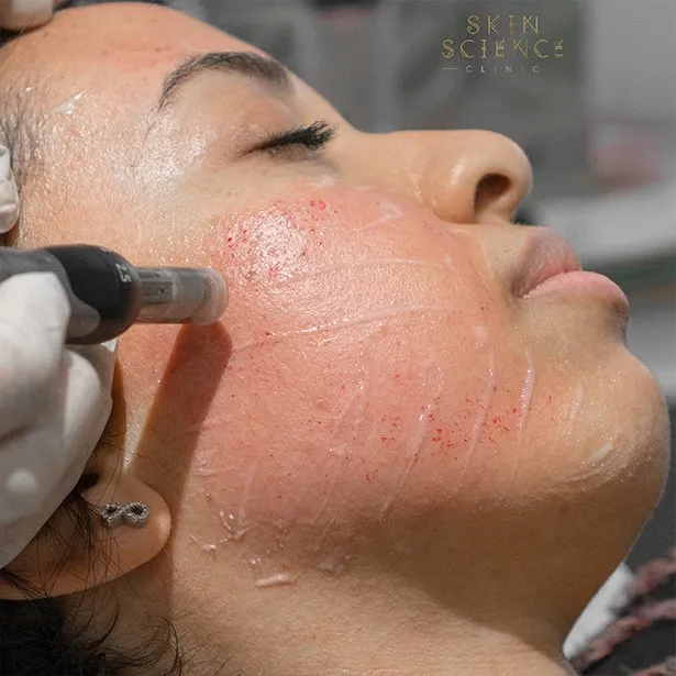 Dermapen treatment