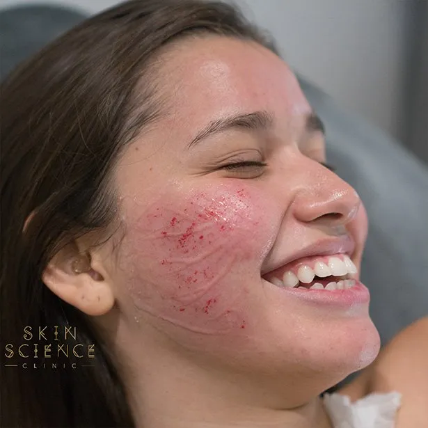 Dermapen treatment on ASOS model Domenica