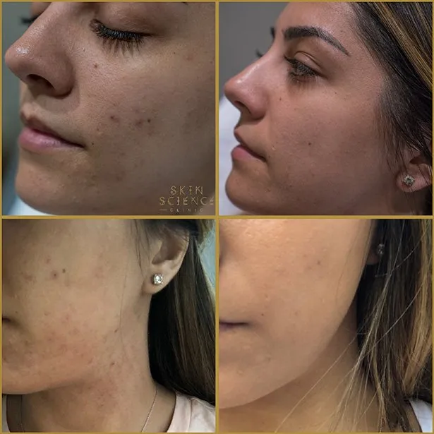 Dermapen before and after on a young woman’s side profile