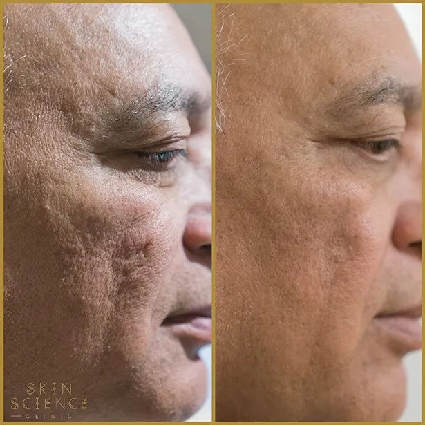 Dermapen before and after on a male face, side profile