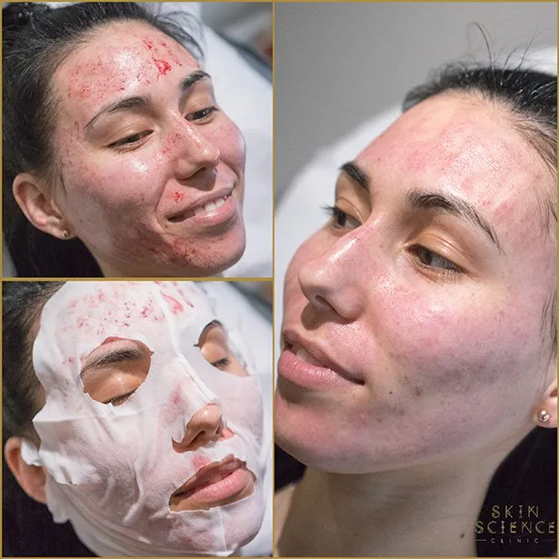 Dermapen before and after on a lady at Skin Science Clinic in London