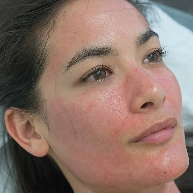Dermapen treatment results on a model