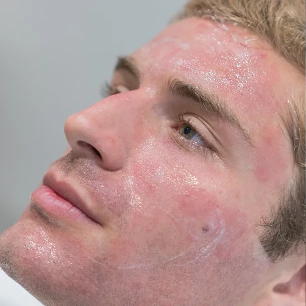Dermapen treatment results on a man