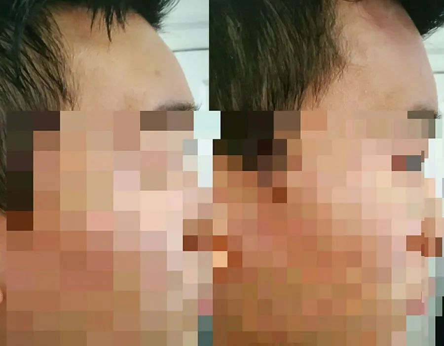Before and after forehead fillers at Skin Science Clinic in London