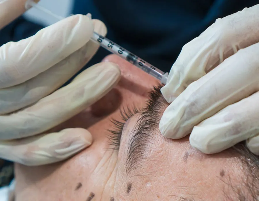 Dr Adil Sarwar injecting forehead fillers on a male patient at Skin Science Clinic in London