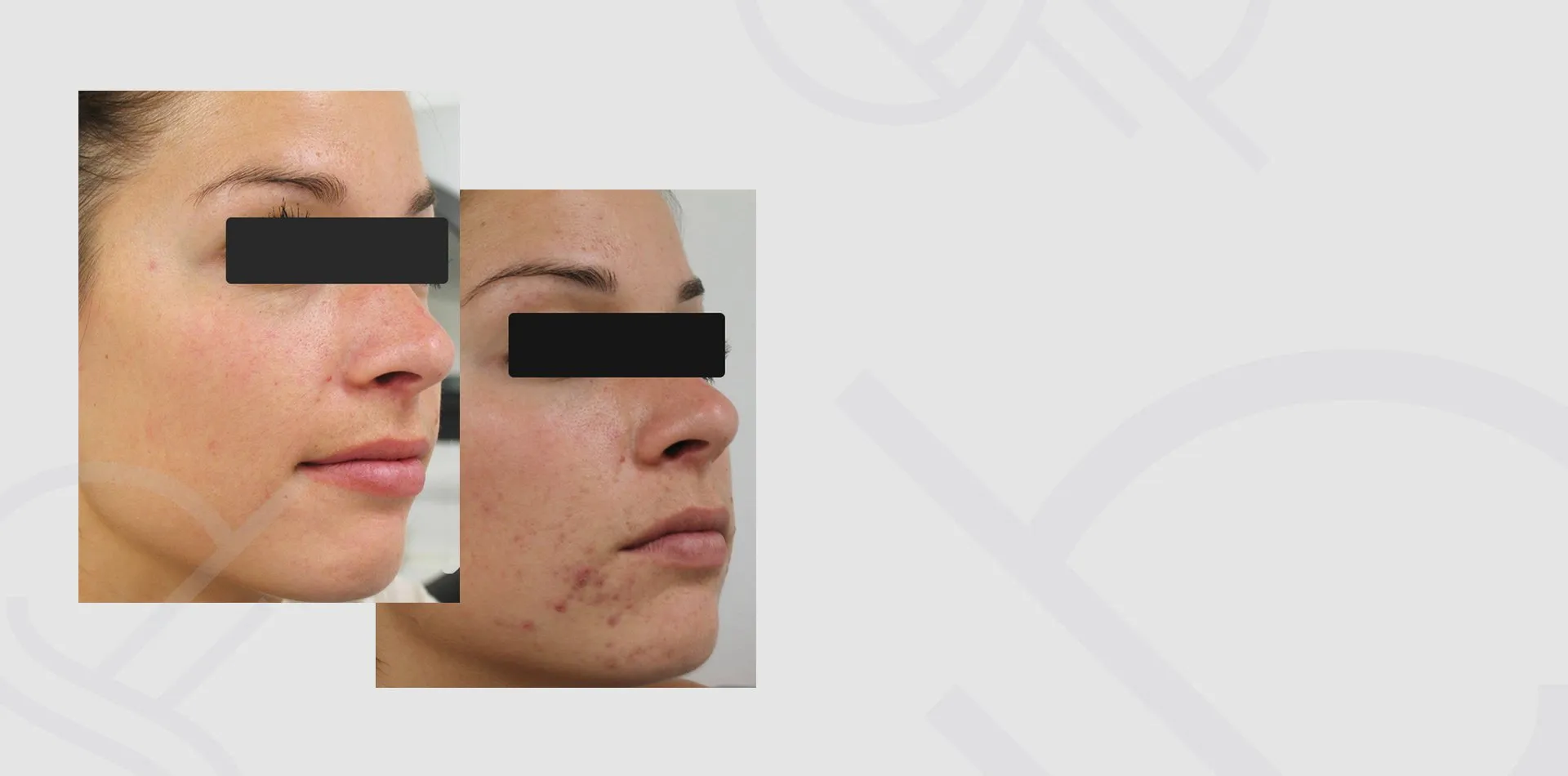 Before and after a glycolic peel at Skin Science Clinic, London