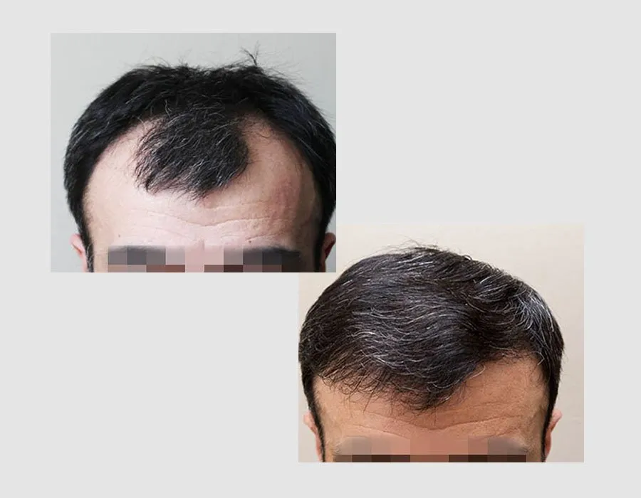 Before and after a hair transplant at Skin Science Clinic in London