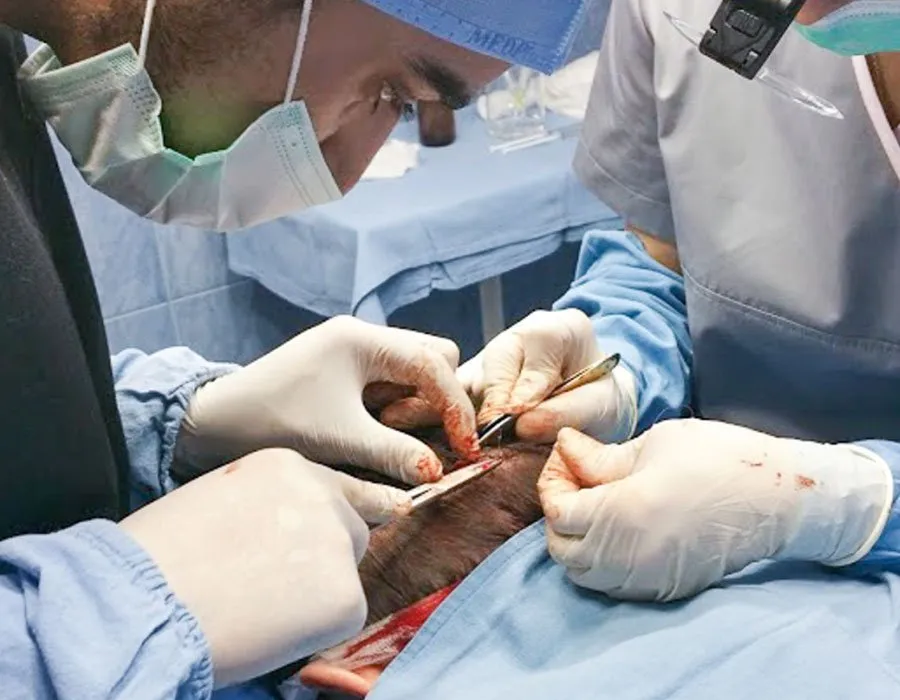 Close-up of a hair transplant operation at Skin Science Clinic in London