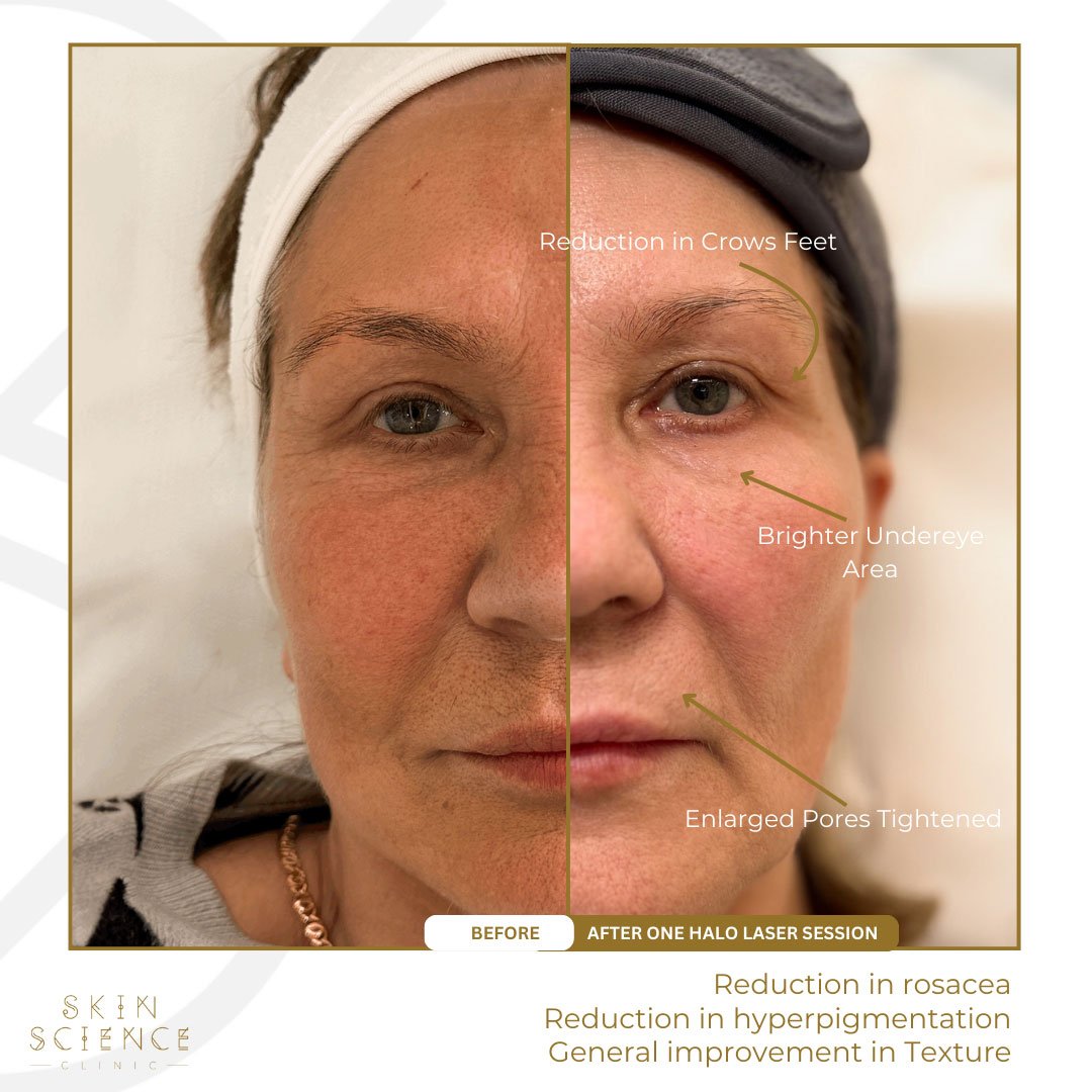 Natalie before and after HALO treatment — detail view
