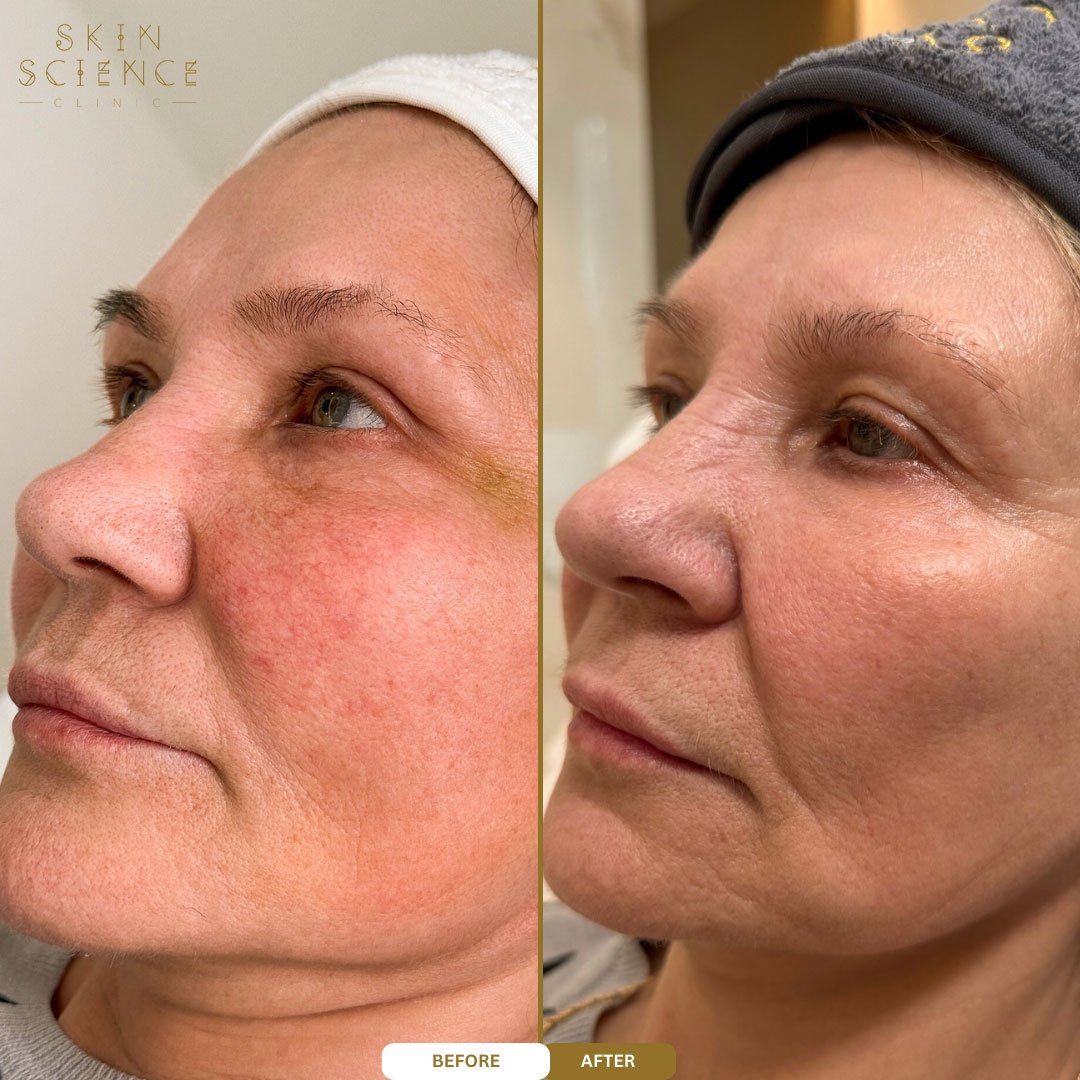 Natalie before and after HALO treatment — profile view
