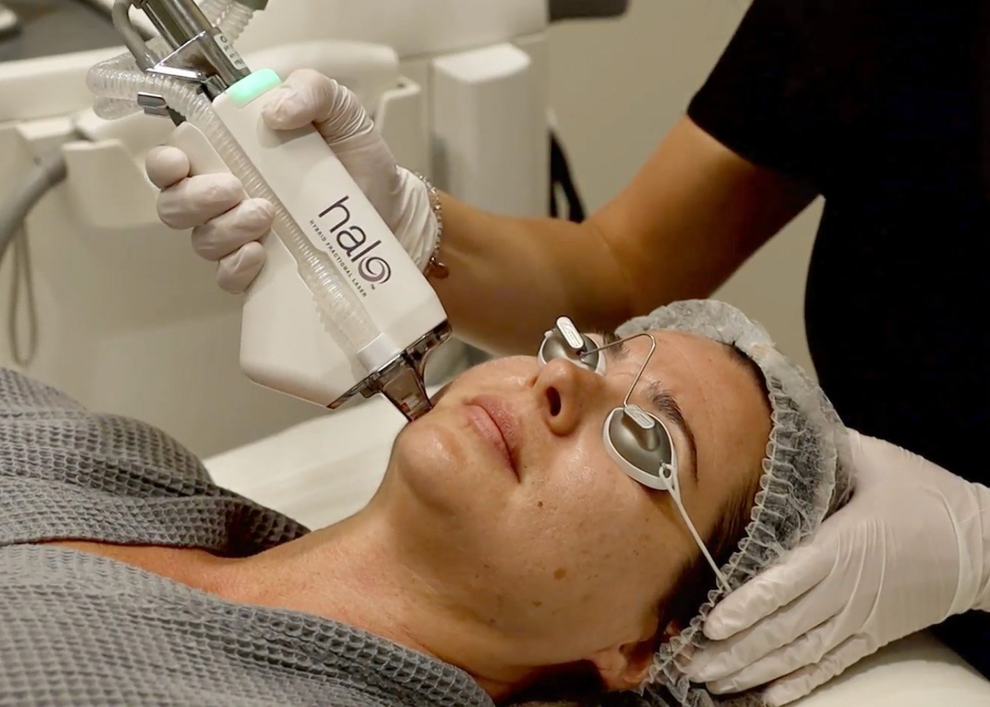 HALO treatment at Skin Science Clinic in London