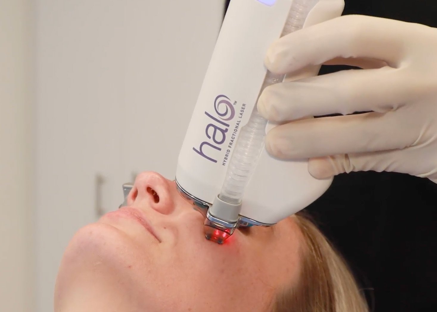 HALO laser treatment on the cheek