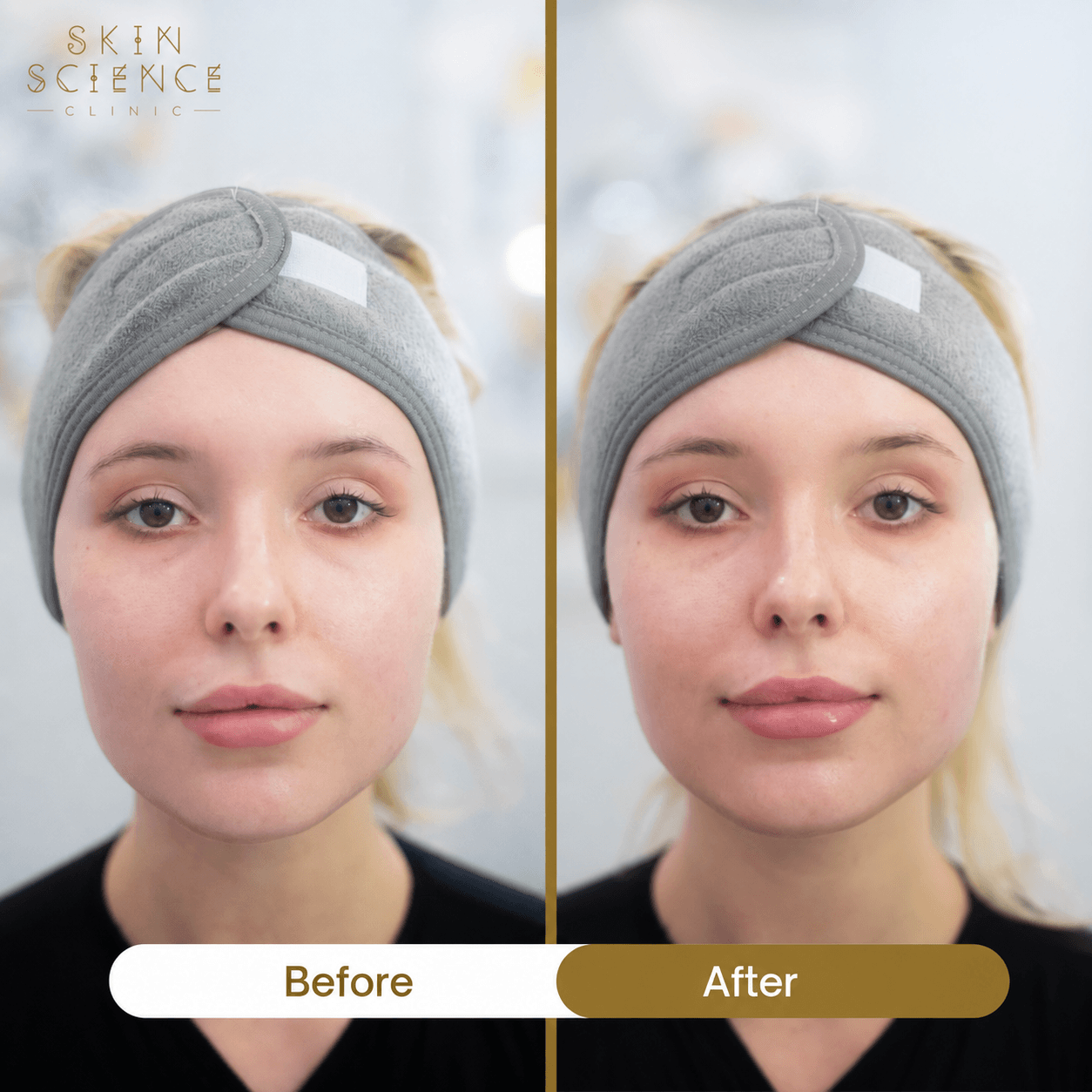 A Skin Science Clinic patient before and immediately after a HydraFacial with Lip Perk in London