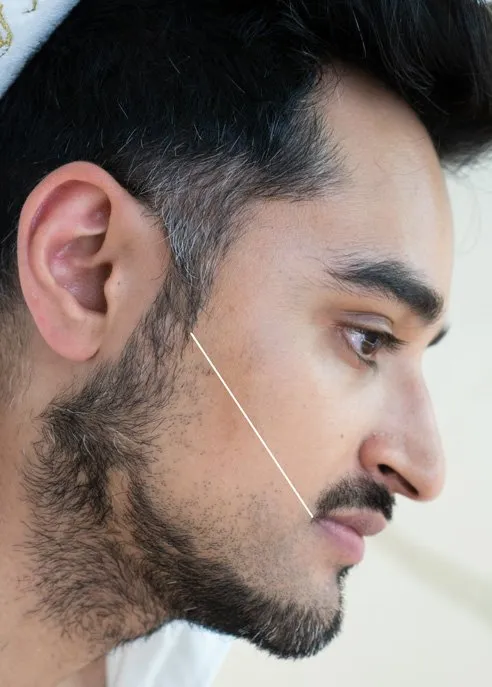Men’s beard laser hair removal in London