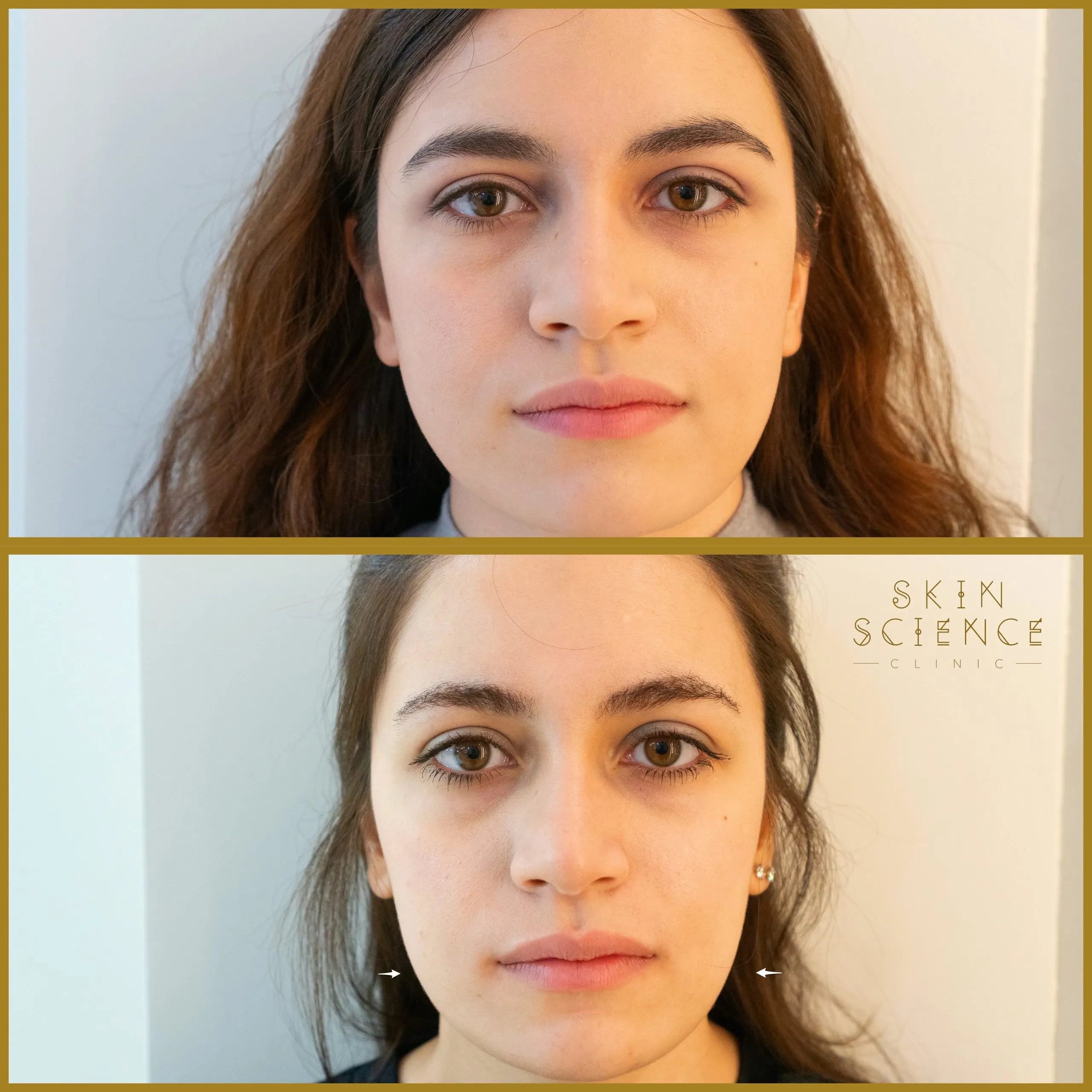 Before and after masseter Botox at Skin Science Clinic, London