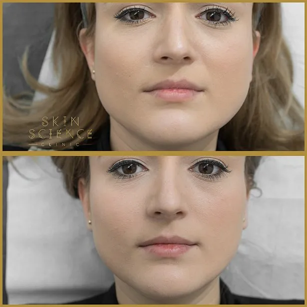 Before and after masseter Botox at Skin Science Clinic, London