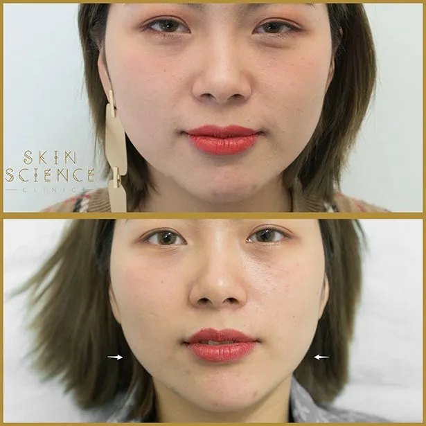 Before and after combined masseter and chin Botox at Skin Science Clinic, London