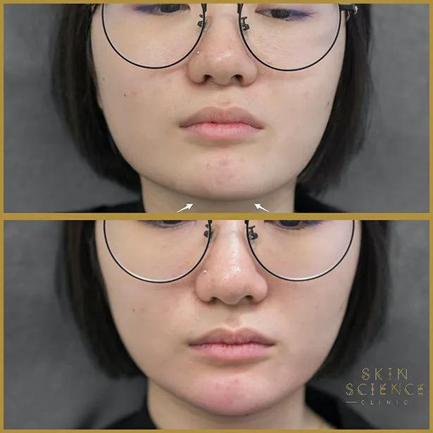 Masseter and chin Botox result at Skin Science Clinic London