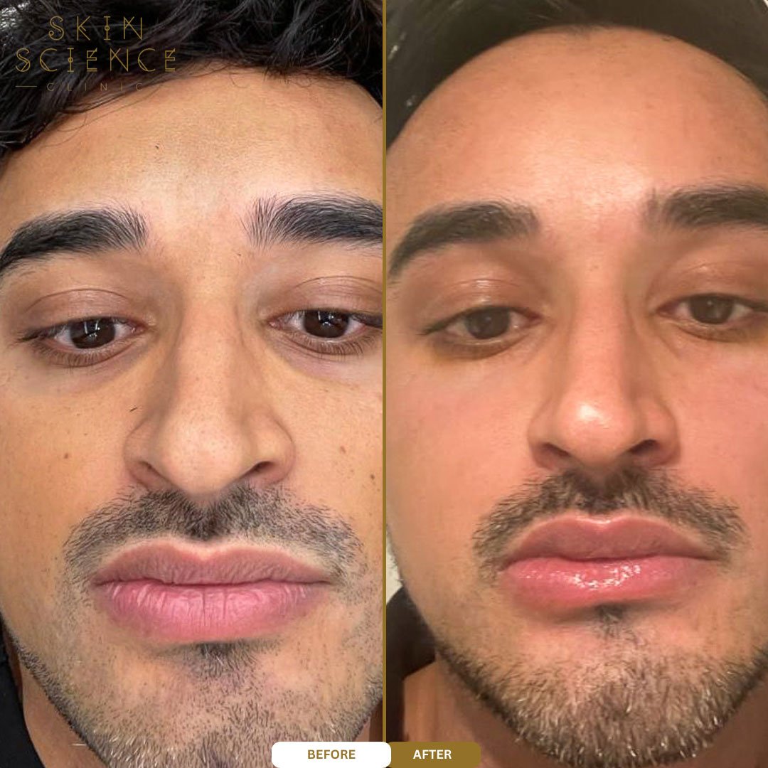 Before and after BBL and MOXI treatment — front view