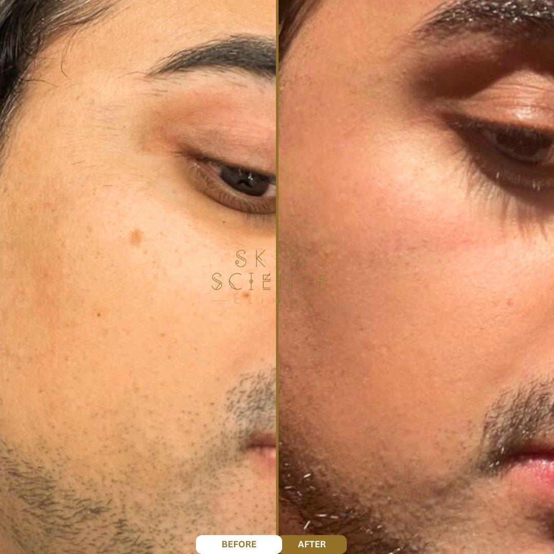 Before and after BBL and MOXI treatment — side profile
