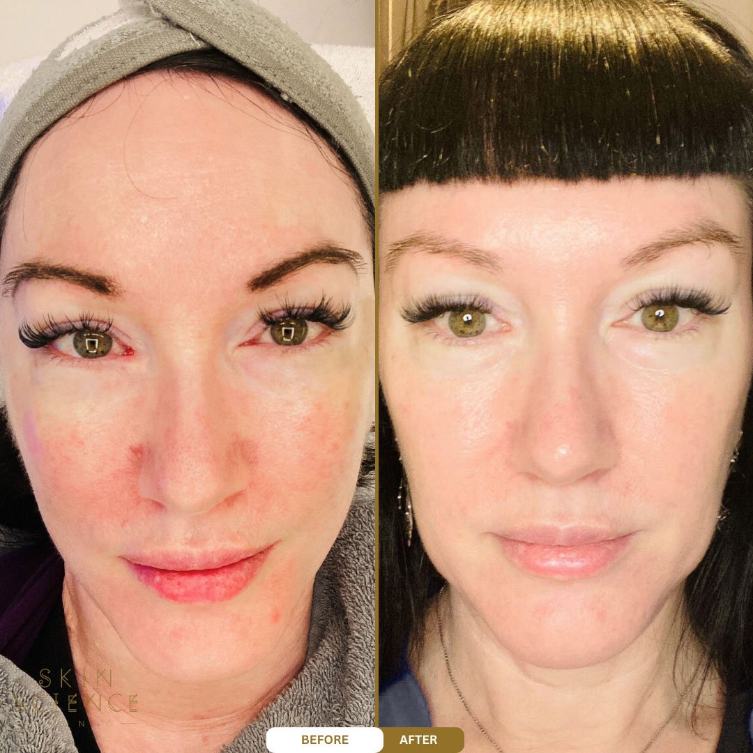 Cleo before and after BBL and MOXI treatment — front view