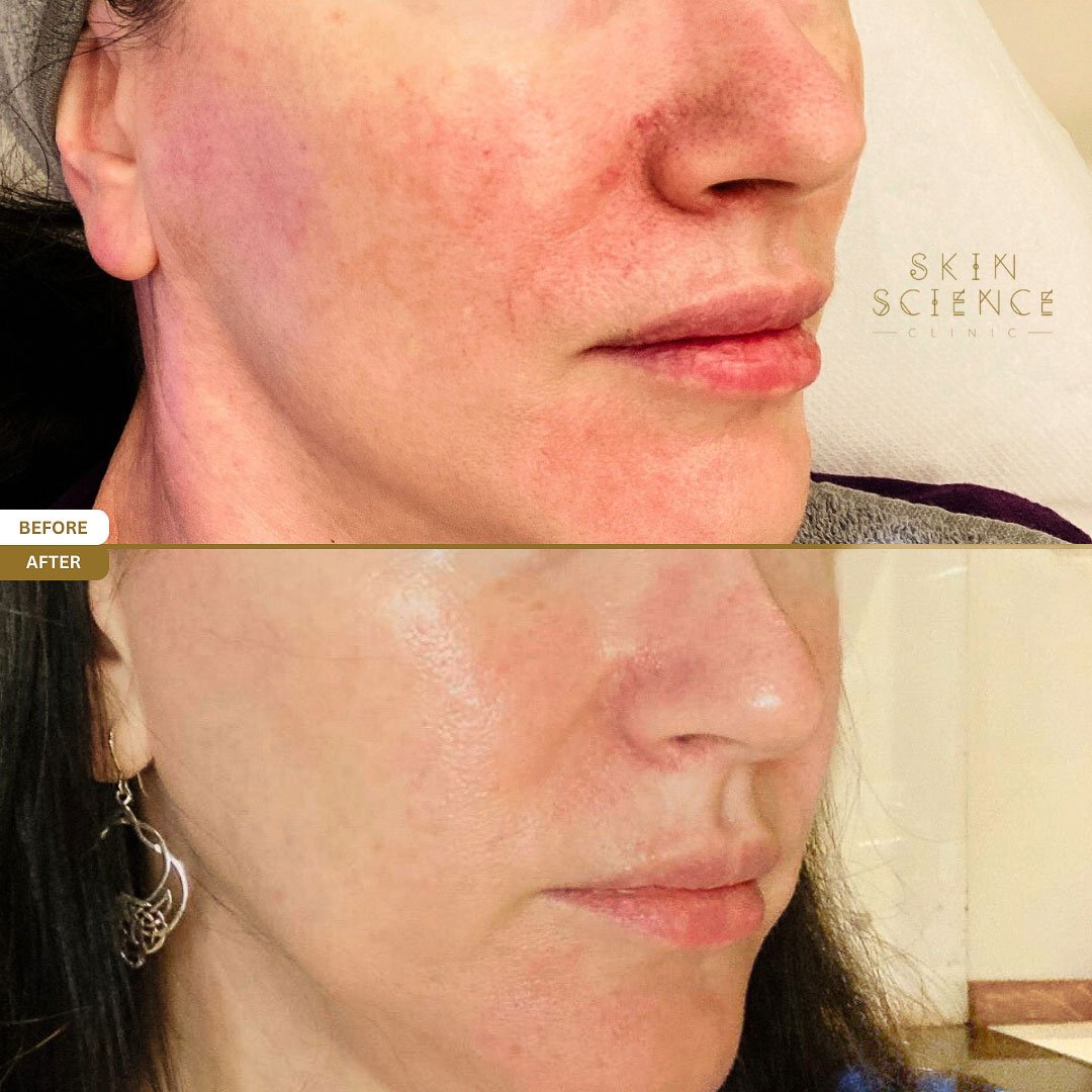 Cleo before and after BBL and MOXI treatment — side profile