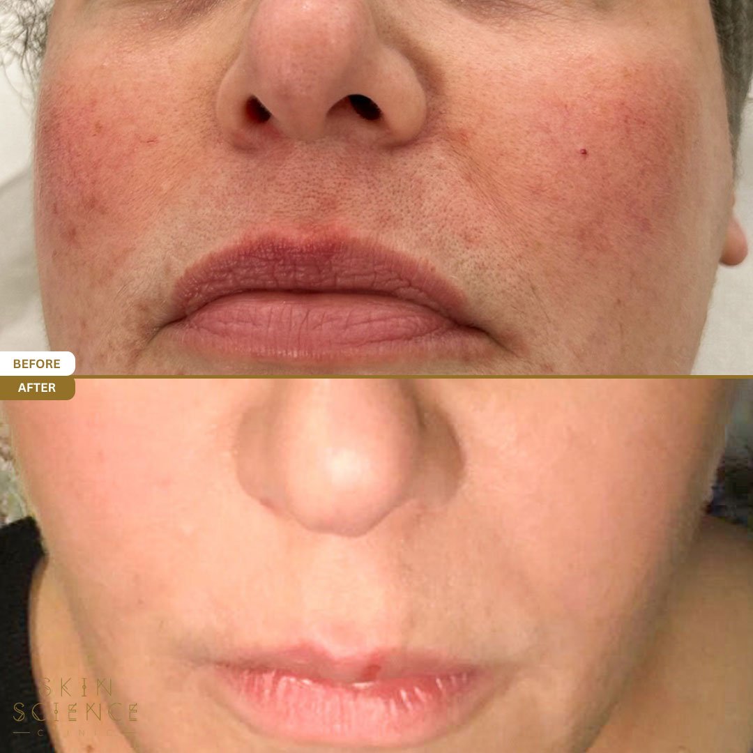 Mel before and after BBL and MOXI treatment — front view