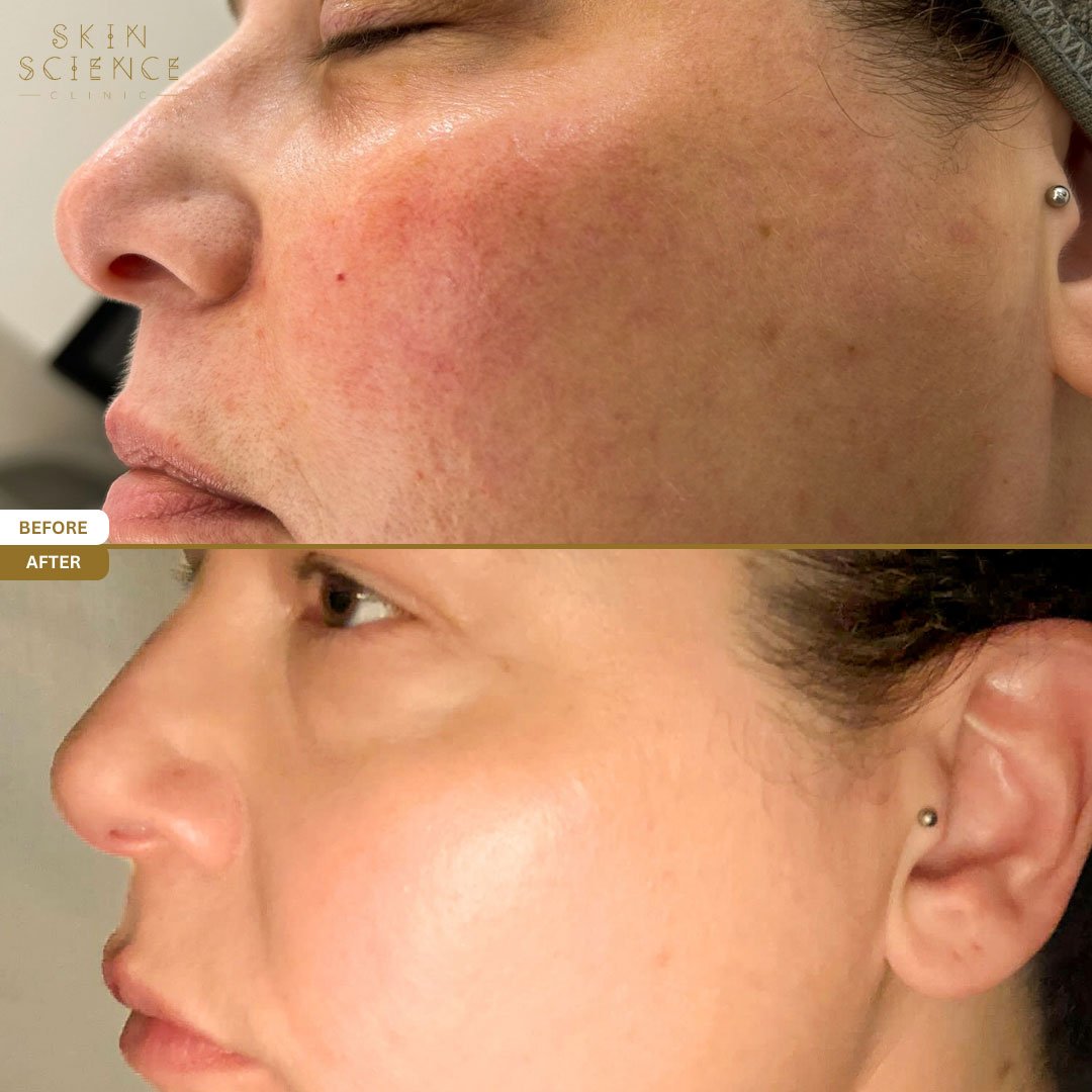 Mel before and after BBL and MOXI treatment — side profile